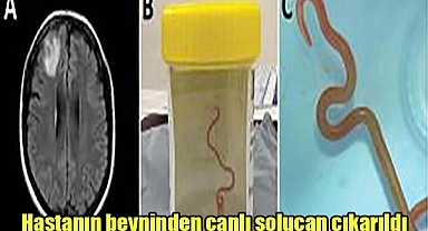 Hastanın beyninden canlı solucan çıkarıldı